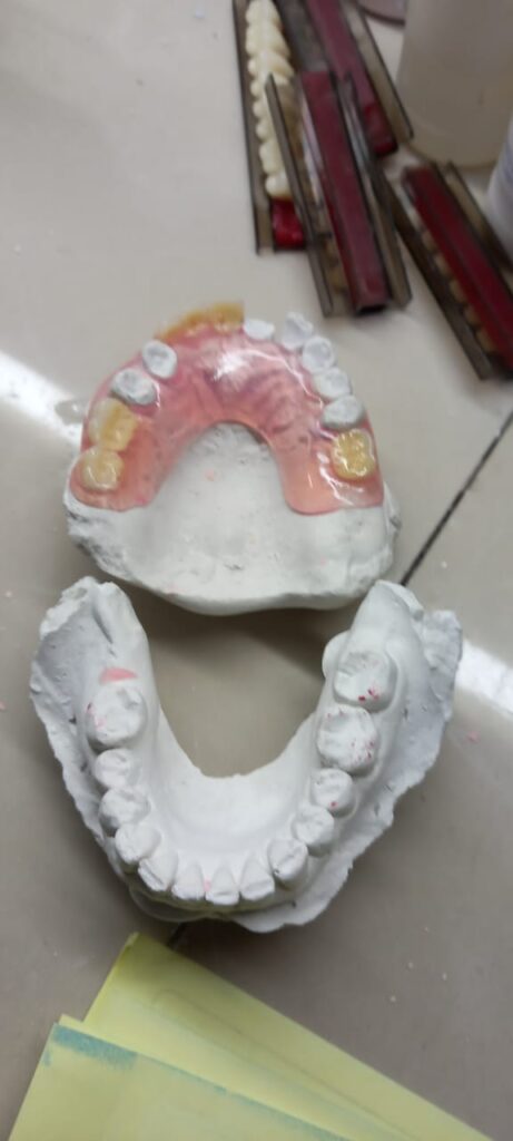pasang gigi palsu kemang