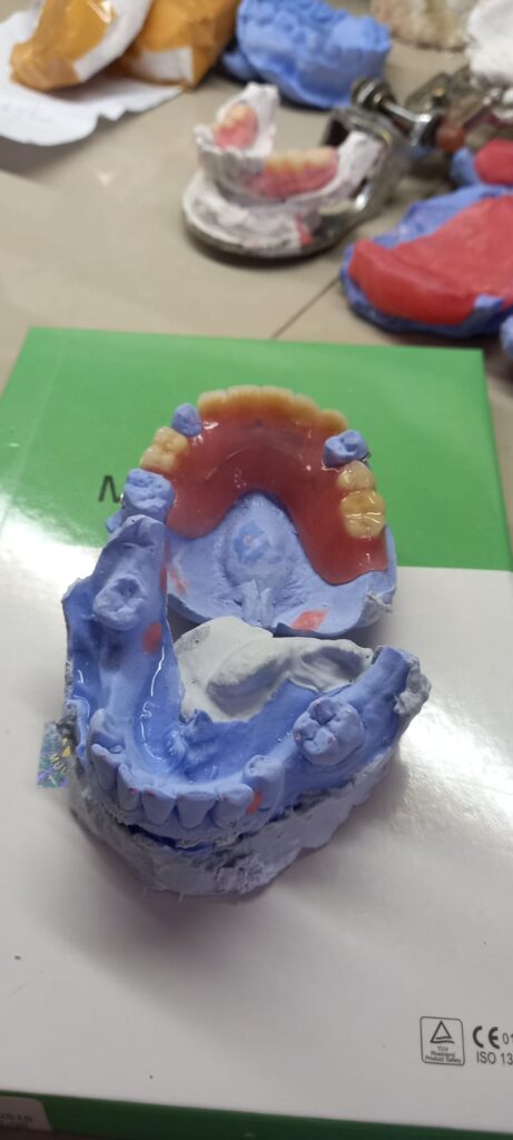 pasang gigi palsu bogor barat